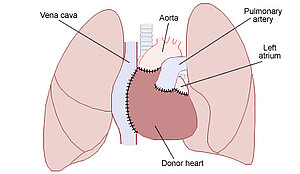 Erste Herztransplantation der Welt