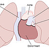 Erste Herztransplantation der Welt