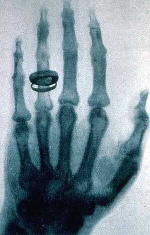 Erstes Röntgenfoto